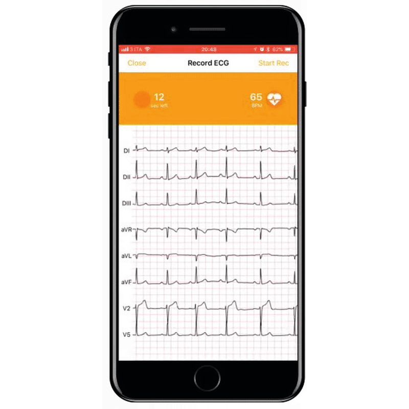 ECG connecté